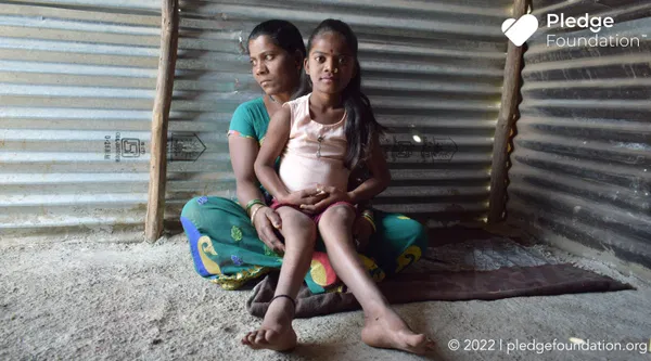 Cure little Rupali’s deformity by supporting her surgery.