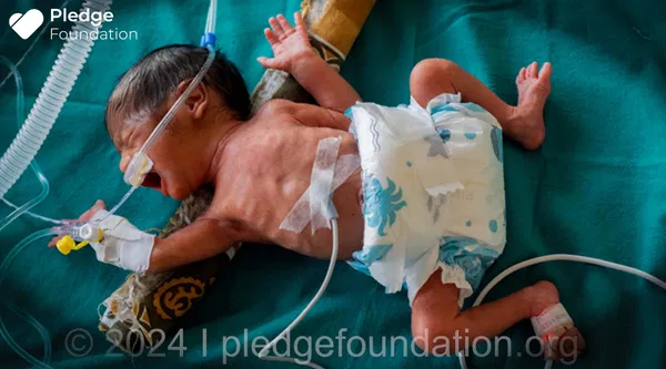 Born Premature in the 7th month of Pregnancy | Mother is Hospitalized | Save life of Newborn
