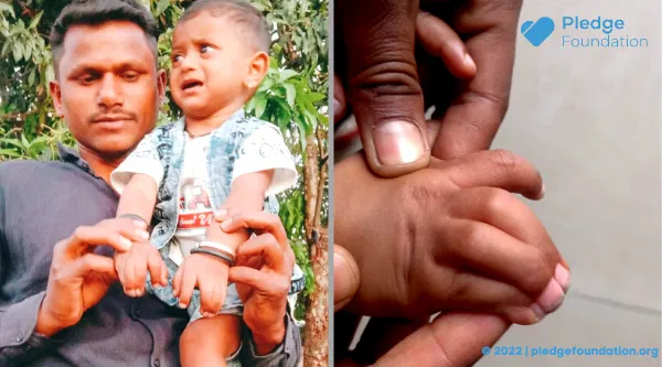 15-month-old Devansh doesn't have Fingers! Support for his Plastic Surgery