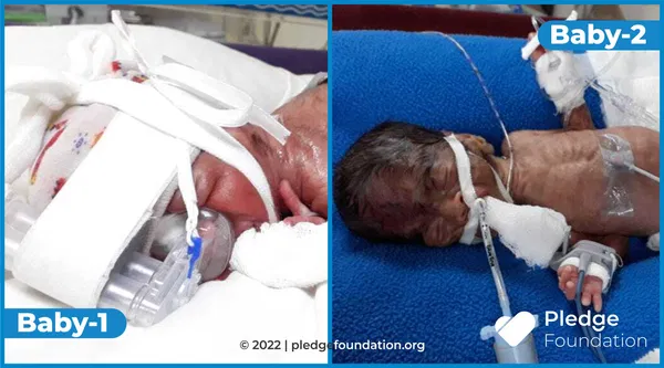 Born in 7 months | Keep these Premature Twins Alive